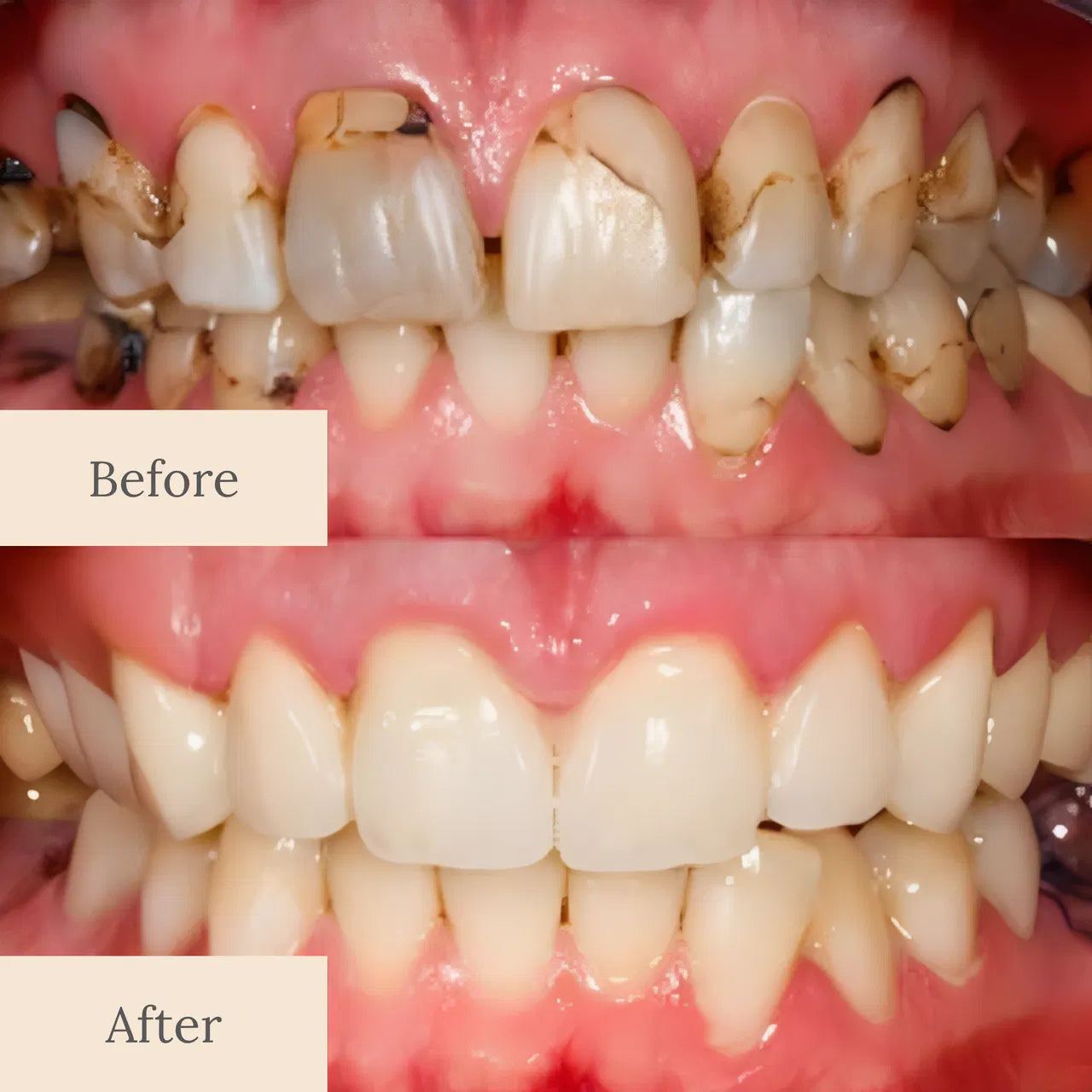 LOVILDS™ Advanced Enamel Repair & Whitening Kit (Includes Free LED Mirror)🔥
